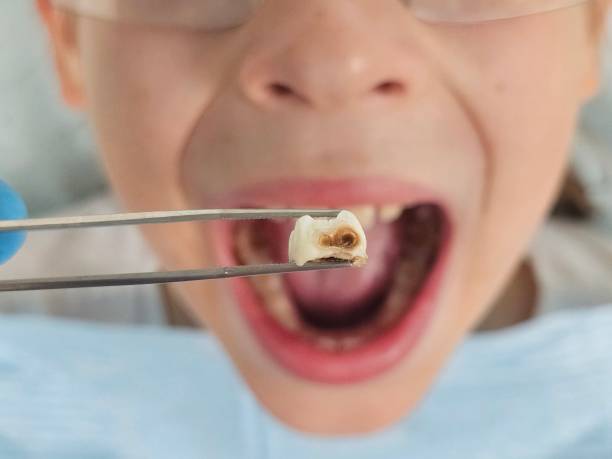 Best Emergency Wisdom Tooth Extraction in Plainview, NE